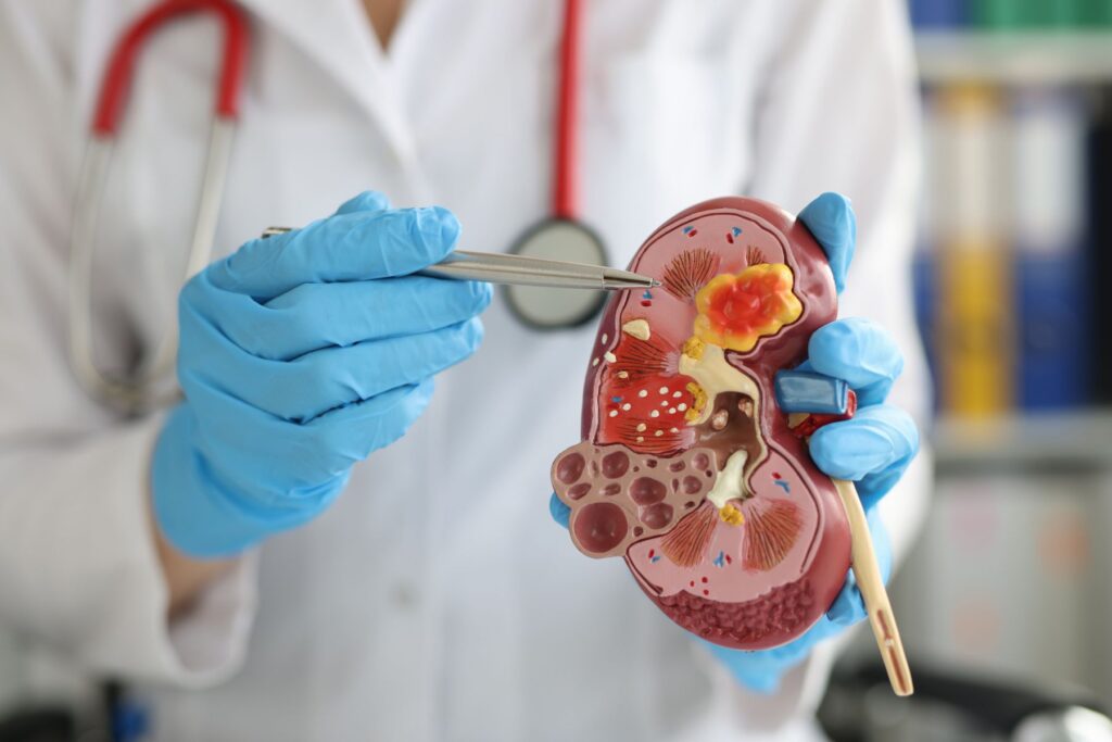 doctor using model kidney to explain kidney stones