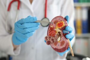 doctor using model kidney to explain kidney stones